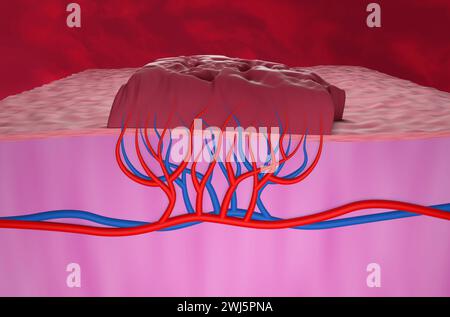 Emangioma tumorale - Vista isometrica illustrazione 3d. Foto Stock