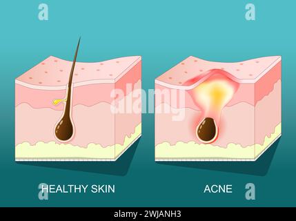Acne. Sezione trasversale di una pelle umana con brufoli, rossore e infiammazione. Poster vettoriale. Illustrazione piatta isometrica. Illustrazione Vettoriale