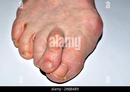 L'immagine mostra un primo piano del piede destro della gamba colpita dalla malattia, l'allux valgus, le dita sono attorcigliate. Foto Stock