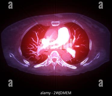 Un'arteria polmonare CTA rivela una vista dettagliata dei vasi sanguigni polmonari, catturando la presenza di embolia polmonare, una condizione in cui una cl ematica Foto Stock