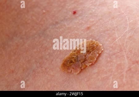 Melanoma benigno - tumore maligno della cute. Foto Stock
