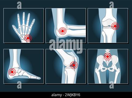 I giunti impostano icone come le immagini radiografiche. Malattia e disturbo della spalla, del ginocchio, della caviglia, del polso e del bacino. Artrite, osteoporosi, reumatismi, infiammazione, Illustrazione Vettoriale
