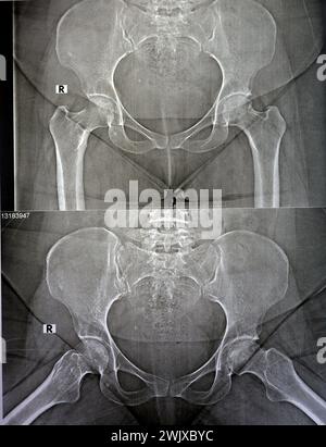 La radiografia semplice rivela necrosi avascolare bilaterale (AVN) della testa femorale più a sinistra, un tipo di osteonecrosi asettica, che è causata da dis Foto Stock