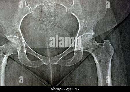 La radiografia semplice rivela necrosi avascolare bilaterale (AVN) della testa femorale più a sinistra, un tipo di osteonecrosi asettica, che è causata da dis Foto Stock