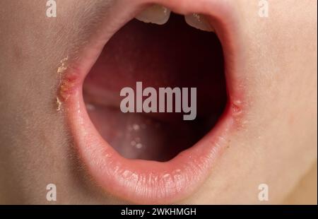 Convulsioni agli angoli delle labbra della bocca di un bambino. Malattia batterica di infiammazione degli angoli delle labbra. Stomatite angolare con ridotta Foto Stock