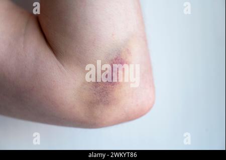Primo piano di un gomito con ematoma di livido, lividi Foto Stock