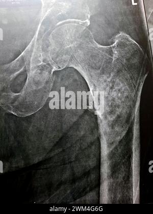 Radiografia semplice con alta probabilità di frattura subtrocanterica, trocanterica e metastasi maligne nel lato mediale dell'albero femorale sottostante Foto Stock