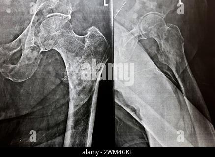 Radiografia semplice con alta probabilità di frattura subtrocanterica, trocanterica e metastasi maligne nel lato mediale dell'albero femorale sottostante Foto Stock