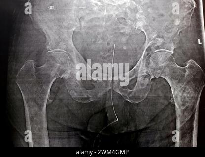 Elevata probabilità di frattura subtrocanterica, trocanterica e metastasi maligne nel lato mediale dell'albero superiore del femore, di una vecchia paziente Foto Stock