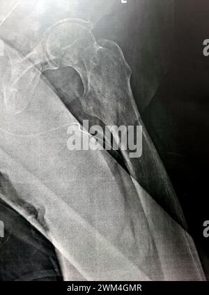 Radiografia semplice con alta probabilità di frattura subtrocanterica, trocanterica e metastasi maligne nel lato mediale dell'albero femorale sottostante Foto Stock