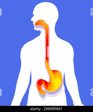 illustrazione 3d dello stomaco e dell'esofago in bocca con fuoco e indigestione. Mostra il sistema digerente sulla sagoma umana ritagliata. Foto Stock