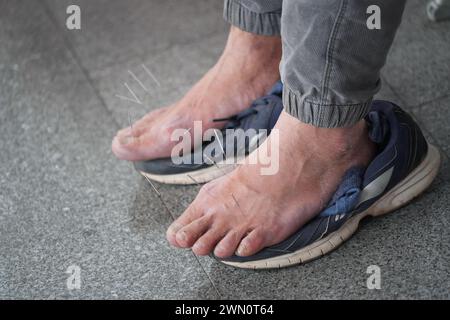 Primo piano di una persona che riceve trattamento di agopuntura in una pratica medica Foto Stock