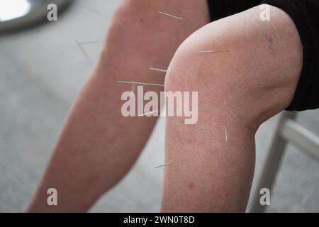 Primo piano di una persona che riceve trattamento di agopuntura in una pratica medica Foto Stock