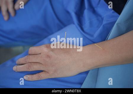 Primo piano di una persona che riceve trattamento di agopuntura in una pratica medica Foto Stock