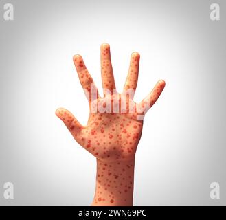 Il concetto di malattia del morbillo come una mano con una malattia virale infezione si diffonde come macchie Koplik sulla pelle e i pericoli di diffusione del virus contagioso Foto Stock