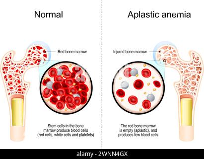 Anemia aplastica. Sezione trasversale di un femore con cedimento del midollo osseo. Primo piano di cellule ematiche. Le cellule staminali nel midollo osseo producono globuli rossi, Illustrazione Vettoriale