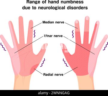 Gamma di intorpidimento delle mani dovuto a disturbi neurologici Illustrazione Vettoriale