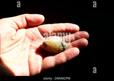 Malattia del calcoli biliari, colelitiasi - la formazione di pietre, calcoli nella cistifellea, dotti biliari. Calcoli biliari. Un grande gallone rimosso da a. Foto Stock