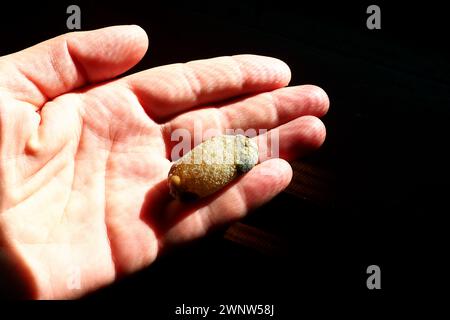 Malattia del calcoli biliari, colelitiasi - la formazione di pietre, calcoli nella cistifellea, dotti biliari. Calcoli biliari. Un grande gallone rimosso da a. Foto Stock