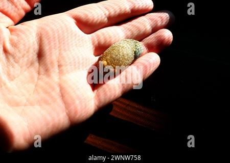 Malattia del calcoli biliari, colelitiasi - la formazione di pietre, calcoli nella cistifellea, dotti biliari. Calcoli biliari. Un grande gallone rimosso da a. Foto Stock