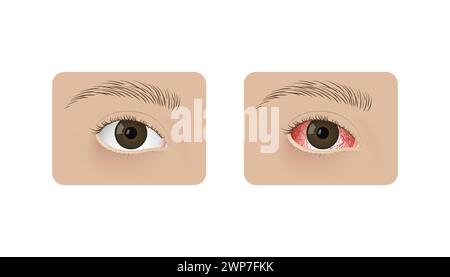Occhio umano sano realistico e con design di illustrazione vettoriale congiuntivite. Sindrome dell'occhio secco rosso, anatomia, salute e allergie. Illustrazione Vettoriale