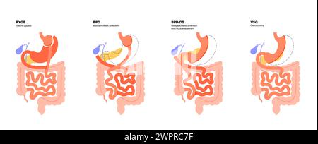 Tipi di chirurgia bariatrica, illustrazione Foto Stock
