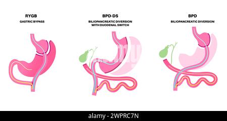 Tipi di chirurgia bariatrica, illustrazione Foto Stock