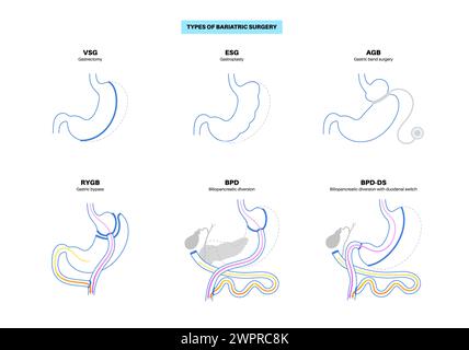 Tipi di chirurgia bariatrica, illustrazione Foto Stock
