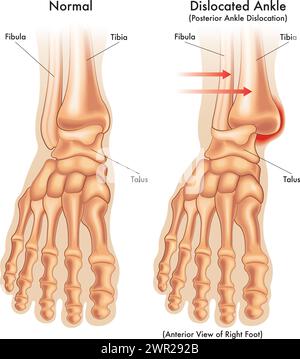 Illustrazione medica che confronta una caviglia normale, con una caviglia dislocata, con annotazioni. Illustrazione Vettoriale