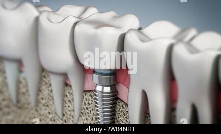 3D rappresentazione di un impianto dentario che mostra la gomma mascellare e gli strati ossei. 3D illustrazione. Foto Stock