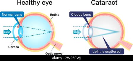 Cause e meccanismo dell'illustrazione del vettore della cataratta Illustrazione Vettoriale