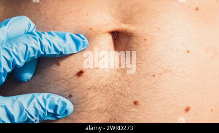 Dermatologo che controlla le voglie maschili. Medico in guanti medici esaminando la talpa della pelle dell'uomo. Cura di sé per prevenire il cancro. Trattamento di protezione. Positività cutanea imperfezione Foto Stock