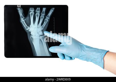 Mano in punti medici blu guanti raggi X del lato della mano di una donna risultato traumatico non comune del trauma del polso Foto Stock