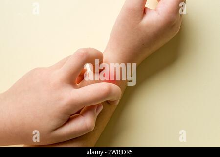 Il morso di insetto sul braccio della ragazza si sta regolando e prurito Foto Stock