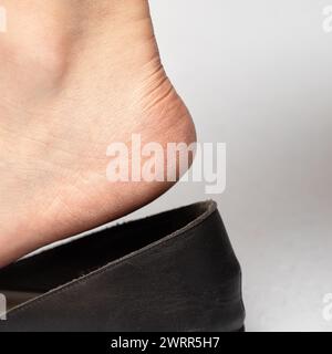 Immagine dettagliata di un piede con pelle asciutta e fessurata sul tallone che entra in una scarpa nera slip-on, evidenziando la necessità di idratazione del piede Foto Stock