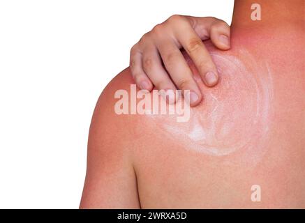 Un uomo con pelle arrossata prurito dopo scottature, spalma la crema sulla pelle. Cura della pelle e protezione dai raggi ultravioletti del sole. Foto Stock