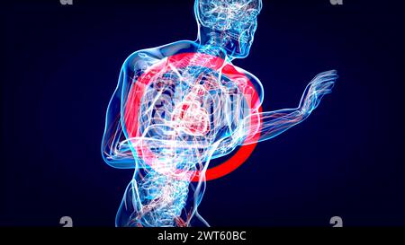 Infarto, illustrazione concettuale, Foto Stock