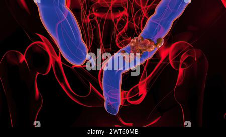 Cancro del colon, illustrazione concettuale. Foto Stock