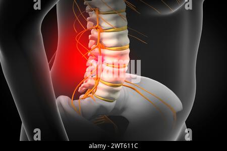 Ernia del disco spinale, illustrazione. Foto Stock