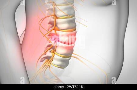 Ernia del disco spinale, illustrazione. Foto Stock