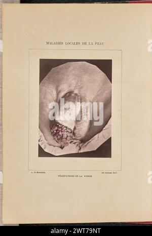 Végétations de la Verge. Arthur de Montmeja, fotografo (francese, nato nel 1841) negativo intorno al 1867, stampa 1882 Vista ravvicinata dei genitali maschili ricoperti di lesioni simili ai cavolfiori. (Recto, Mount) centro superiore, stampato con inchiostro nero: 'MALADIES LOCALES DE LA PEAU' in basso a sinistra, stampato con inchiostro nero: 'A. de Montmeja' centro inferiore, stampato con inchiostro nero: 'VÉGÉTATIONS DE LA VERGE' in basso a destra, stampato con inchiostro nero: 'Ad naturam fecit' Foto Stock
