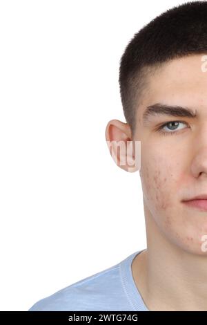 Giovane con problemi di acne isolato sul bianco Foto Stock