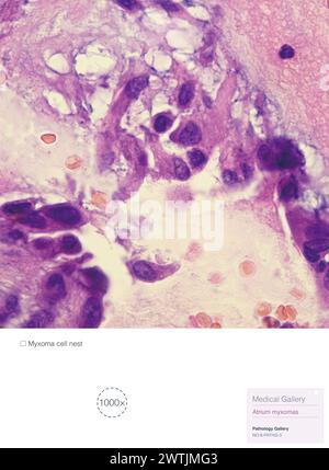 Questa fotografia patologica evidenzia il nido cellulare del mixoma dell'atrio. Il mixoma atriale è un tumore benigno del cuore. Foto Stock