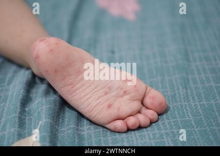 Vista ravvicinata dei piedi del bambino infettati da mani piedi e afta epizootica o HFMD originati da enterovirus o virus coxsackie, zoom shot. Foto Stock