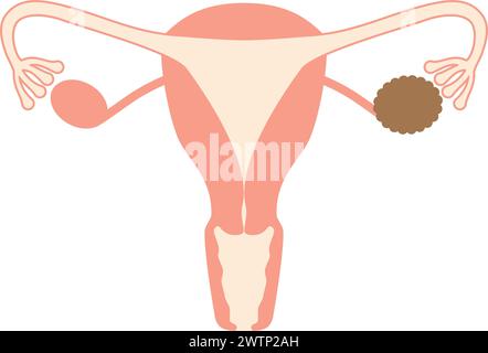 Illustrazione diagrammatica di cisti ovariche, anatomia dell'utero e delle ovaie, illustrazione vettoriale Illustrazione Vettoriale