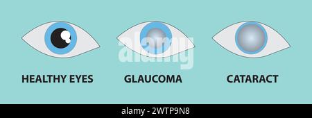 Illustrazione di un occhio sano, glaucoma, cataratta Illustrazione Vettoriale