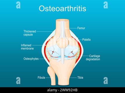 Osteoartrite. Artrite di un'articolazione del ginocchio. Dolore al ginocchio. Malattia degenerativa articolare. Illustrazione vettoriale piatto isometrico Illustrazione Vettoriale