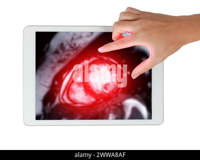 Le immagini RM cardiache su tablet sono fondamentali per valutare lo stato di salute del cuore, identificare le anomalie cardiache isolate su sfondo bianco,.Clipping Pat Foto Stock
