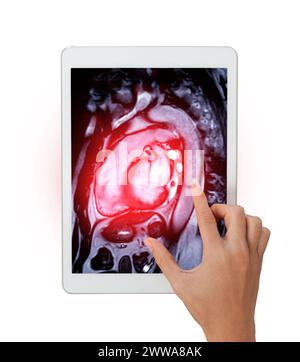 Le immagini RM cardiache su tablet sono fondamentali per valutare lo stato di salute del cuore, identificare le anomalie cardiache isolate su sfondo bianco,.Clipping Pat Foto Stock