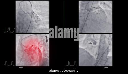 La cateterizzazione cardiaca è una procedura medica utilizzata per esaminare i vasi sanguigni del cuore. Foto Stock